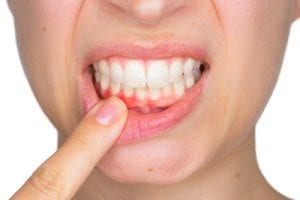 Closeup portrait of young woman showing with his finger inflamed lower gingiva with pain expression. Dental care and toothache