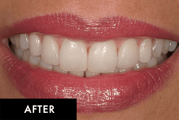 Smile Makeover Patient After