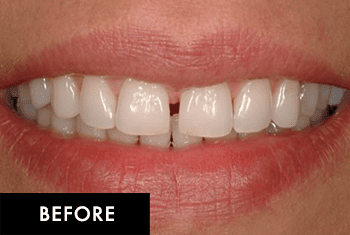 Smile Makeover Patient Before