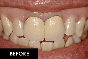 Smile Makeover Patient Before 4