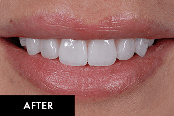 Smile Makeover Patient After 5