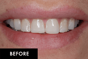 Smile Makeover Patient Before 5