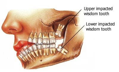 wisdom-teeth-surgery