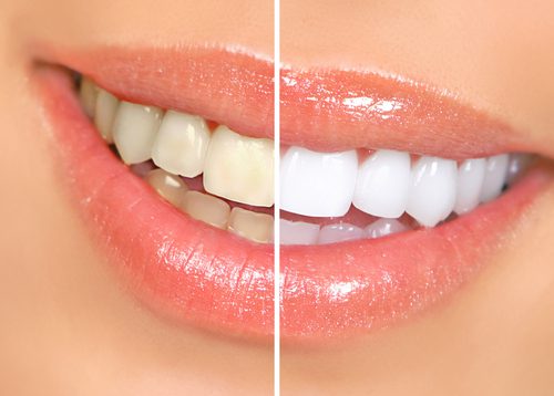 woman teeth before and after whitening-img-blog