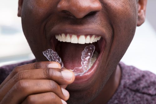 man adjusting transparent aligners in his white teeth-img-blog