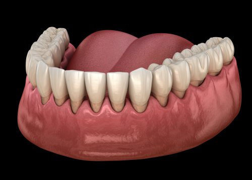 gum recession process. medically accurate 3D illustration-img-blog