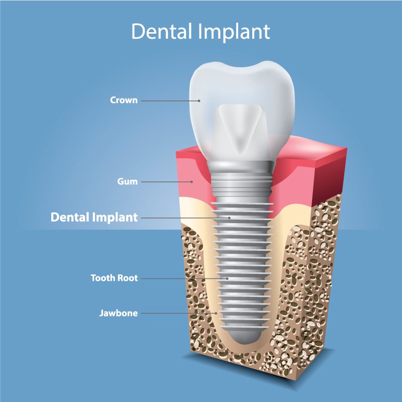 Dental implant detailed image