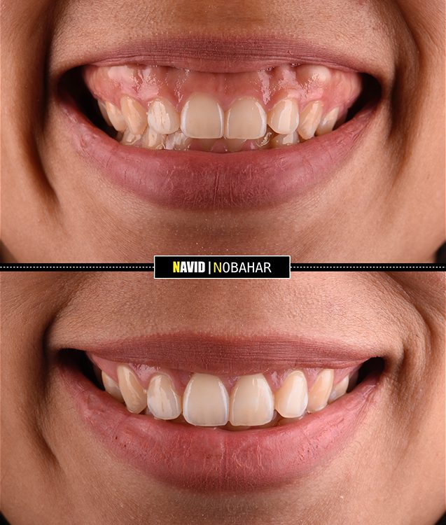 Gum correction before and after results