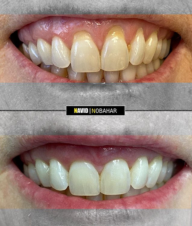 Gum recession before and after results