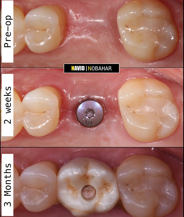 Tooth replacement results