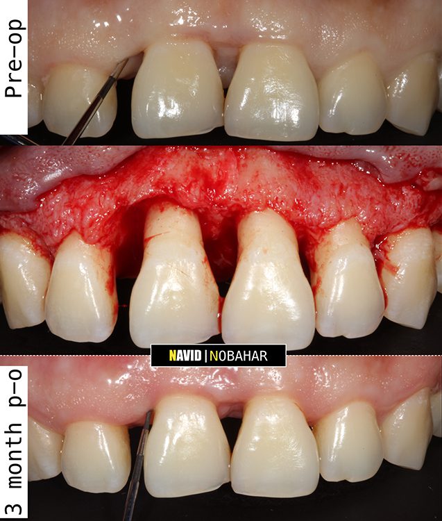 Gum surgery results