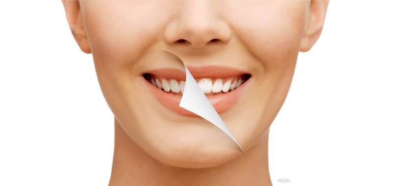 Woman smiling, demonstrating before and after teeth whitening.