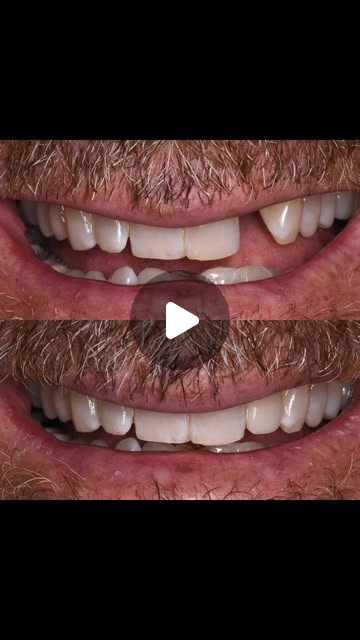 Sometimes a tooth’s own worst enemy…is its own opposing tooth After years of occlusal trauma- what most people think of as just “wear and tear”- this patient’s tooth cracked off below the gum line. No pain. . . . . We try to prevent this kind of trauma with orthodontic movement to obtain a more harmonious, functional bite…but if prevention isn’t prioritized and the unthinkable happens…there are always solutions #dentistry #smile #implant